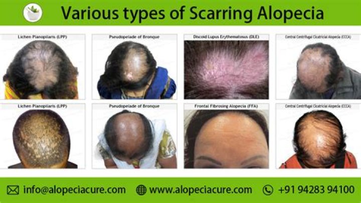 5 Tips for Treating Hair Loss and Scarring Caused by Alopecia