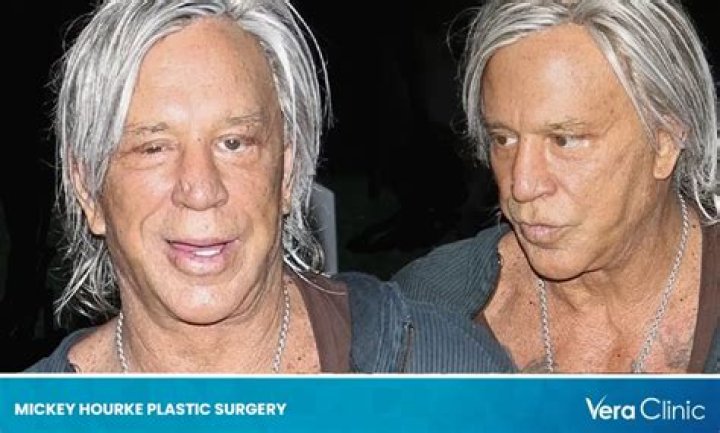 Photos: Mickey Rourke Plastic Surgery; Before & After Transformation Update