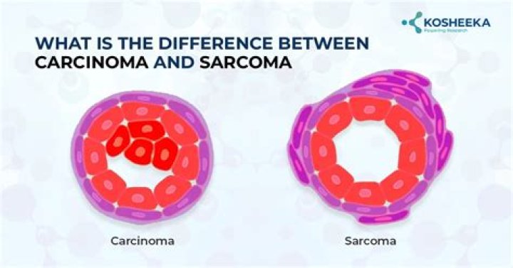 What is the Difference Between Carcinoma and Sarcoma